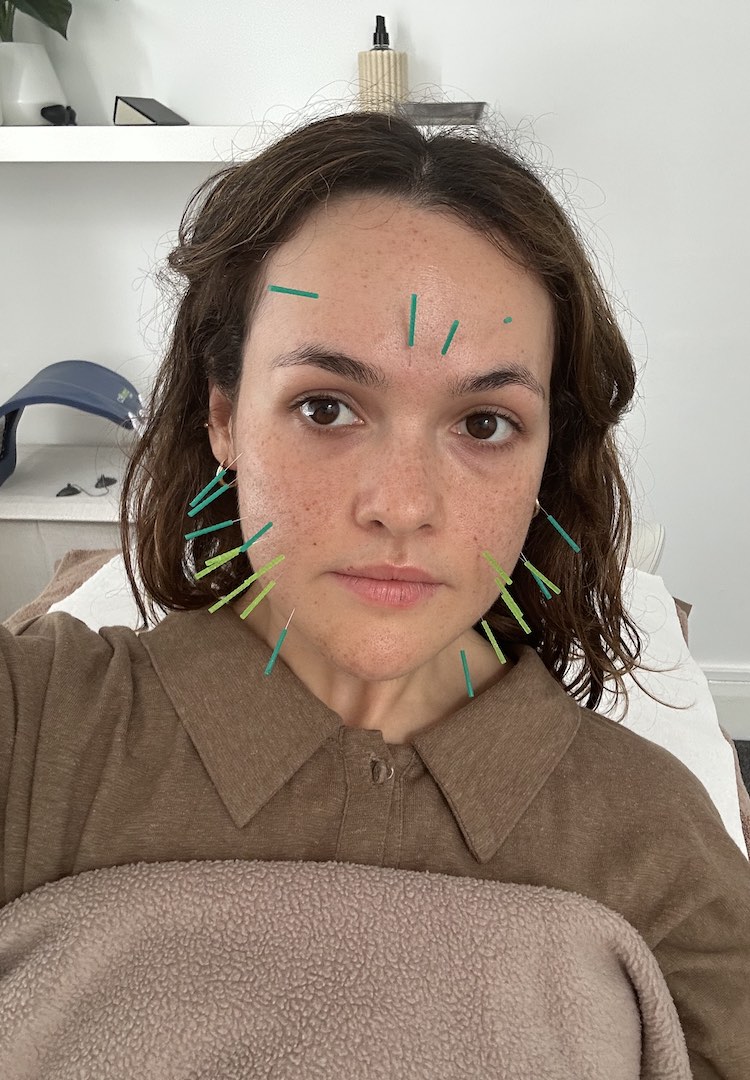 Everything you need to know about cosmetic acupuncture